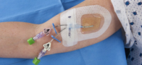 Tegaderm Reducing CLABSI at the Bedside
