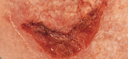 medical adhesive-related skin injury (MARSI)