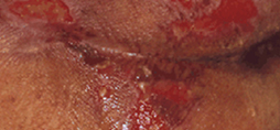 pressure injury