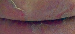 medical adhesive-related skin injury (MARSI)