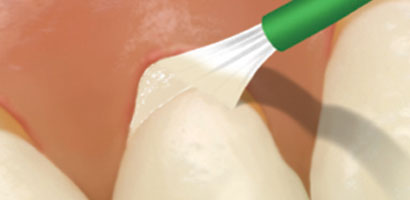 Treat (Fluoride Treatment)
