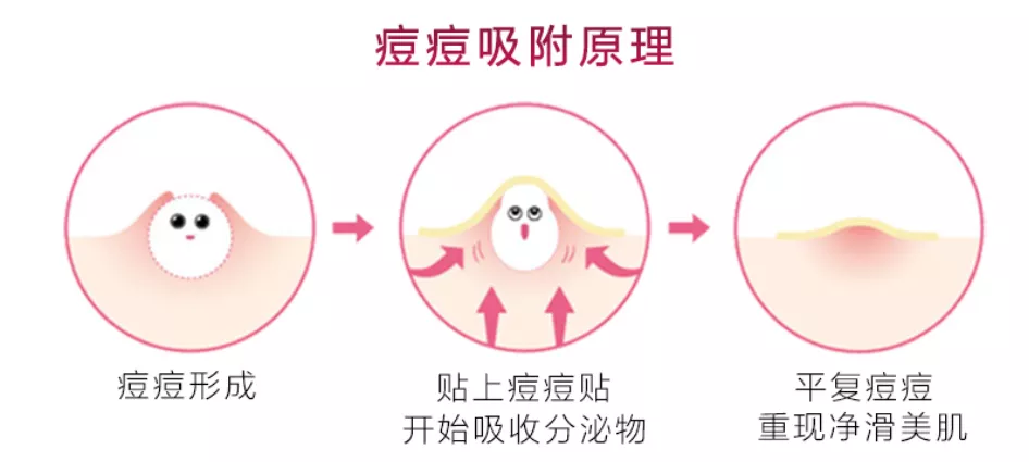 痘痘贴的吸附原理