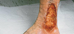 Chronic wound