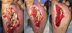 Acute and traumatic wound
