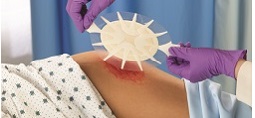 Considering the Connection Between Incontinence-Associated Dermatitis and Pressure Injuries article